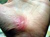 Hand Abrasion - 30 days 4 hours 43 minutes after injury.JPG
