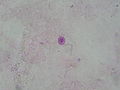 Cryptococcus smear PAS 2010-01-26.JPG