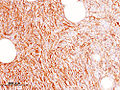 Dermatofibrosarcoma protuberans (5) CD34.JPG