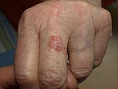 Two coalescing, red, scaly patches on the dorsal surface of an adult finger