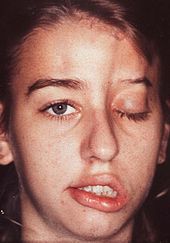 A young girl with facial palsy, complete ptosis, and marked atrophy of subcutaneous and bony structures on the left upper side of the face
