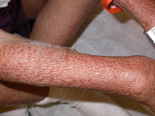 Multiple reddish-brown papules coalescing over the right arm of a boy