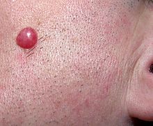 A solitary, large, red papule on the left cheek of an adult male