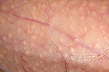 Small, raised, skin-colored lesions