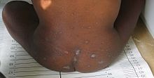 Small, scattered bumps on a child's lower back and buttock