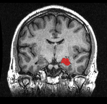 MRI coronal view of the hippocampus shown in red.