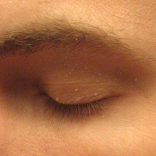 Close-up view of an adult eyelid on which there are numerous small, elevated skin lesions filled with white material