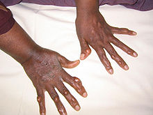 Multiple nodules on the hands of an adult