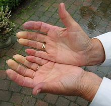 White and red discoloration of the distal fingertips