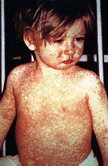 Young child with a red rash covering face, chest, shoulders, and arms.