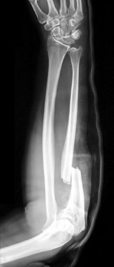 X-ray of right forearm showing ulnar fracture and radial dislocation