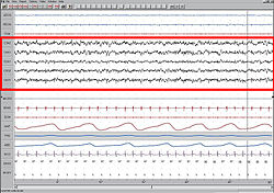 Stage1 Sleep. EEG highlighted by red box.