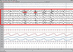 Stage 2 Sleep. EEG highlighted by red box. Sleep spindles highlighted by red line.