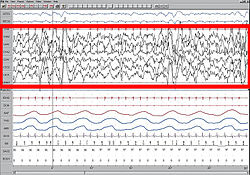 Stage 4 Sleep. EEG highlighted by red box.